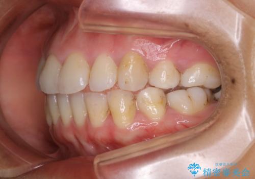 1年ぶりのクリーニング(PMTC)の治療前