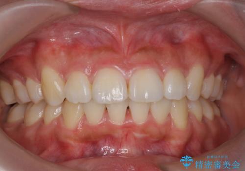 オフィスホワイトニングで、歯を白く!!の治療前