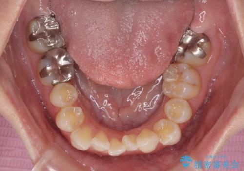 八重歯と前歯の欠損と骨格のズレ 目立たないワイヤー矯正の治療前