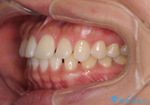 【モニター】前歯のすきっ歯をインビザラインで改善の治療前