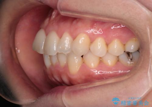 【インビザライン 】前歯のガタガタを治したいの治療前