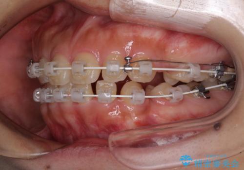 口元を引っ込めたい　目立たないワイヤー装置での抜歯矯正の治療中