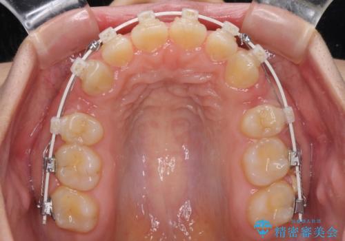 口元を引っ込めたい 目立たないワイヤー装置での抜歯矯正の治療中