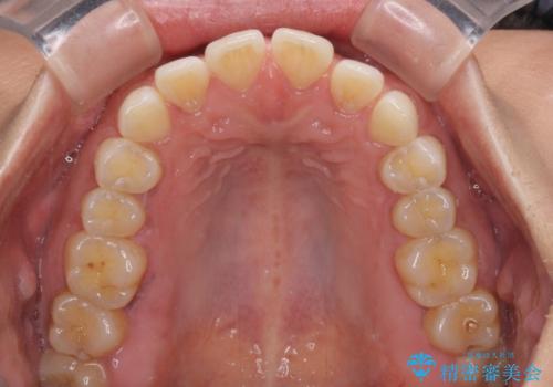 【モニター】前歯のすきっ歯をインビザラインで改善の治療前