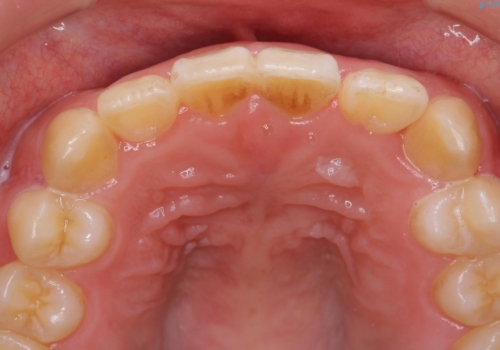 前歯のねじれを治したい (部分矯正を併用したマウスピース矯正)の治療中