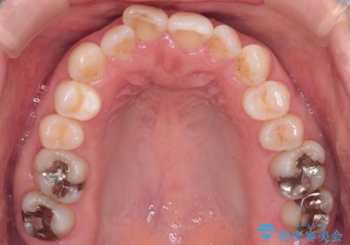 【インビザライン 】前歯のガタガタを治したいの治療前