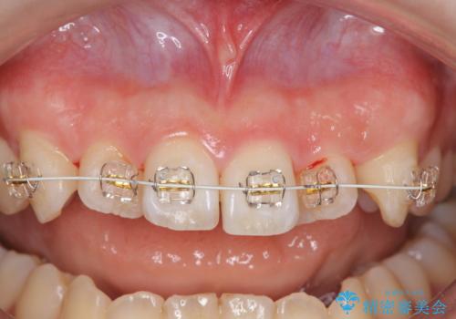 前歯のねじれを改善 小矯正+マウスピース矯正インビザラインの治療中