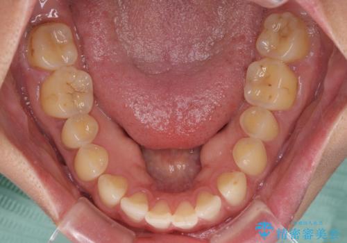 【モニター】前歯のすきっ歯をインビザラインで改善の治療前