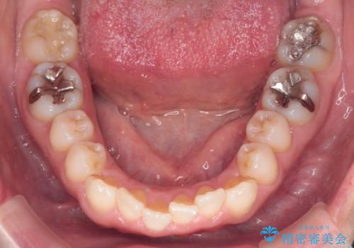 【インビザライン 】前歯のガタガタを治したいの治療前