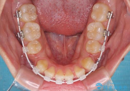 口元を引っ込めたい 目立たないワイヤー装置での抜歯矯正の治療中