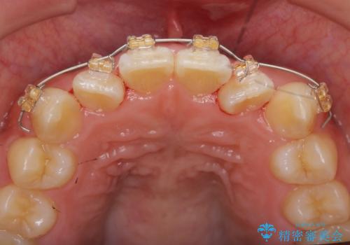 前歯のねじれを改善　小矯正+マウスピース矯正インビザラインの治療中