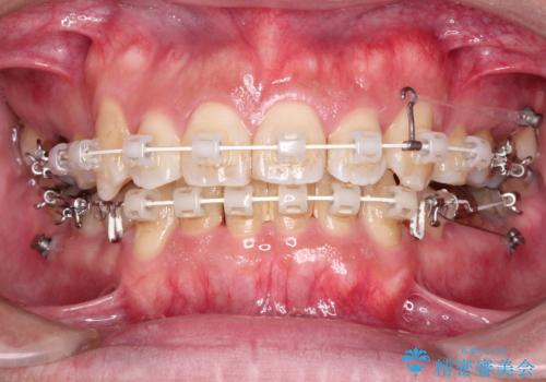 飛び出た八重歯!コンプレックスを払拭!の治療中