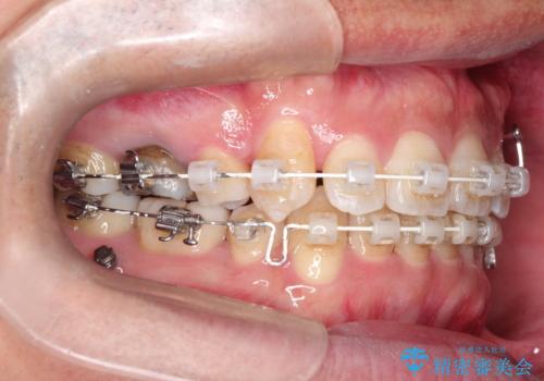 飛び出た八重歯!コンプレックスを払拭!の治療中