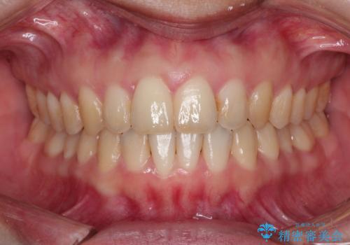 【出っ歯(飛び出した前歯)・がたつきでお悩みの方必見】インビザライン矯正の症例の症例 治療後