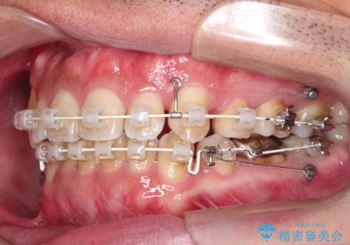 飛び出た八重歯!コンプレックスを払拭!の治療中