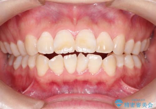 【審美ワイヤー】口ボコをなおしたいの治療前