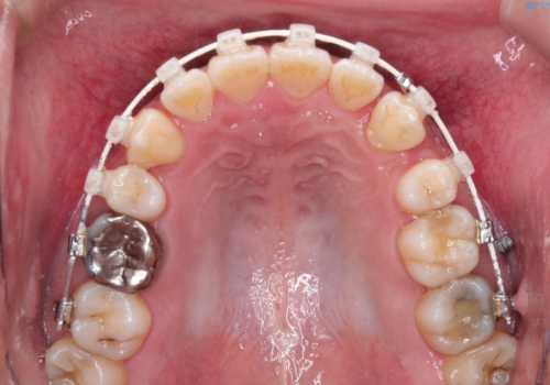 飛び出た八重歯!コンプレックスを払拭!の治療中