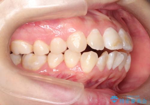 【審美ワイヤー】口ボコをなおしたいの治療前