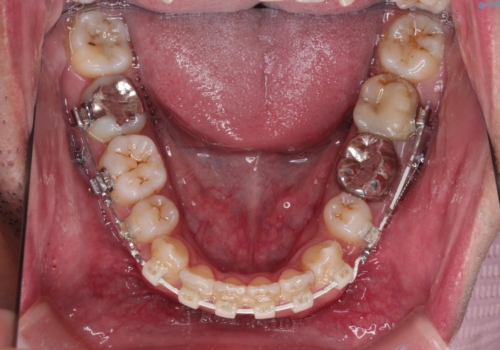 飛び出た八重歯!コンプレックスを払拭!の治療中