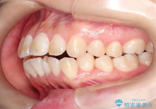 【審美ワイヤー】口ボコをなおしたいの治療前