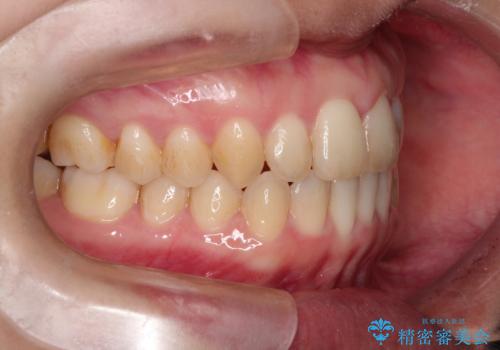 【出っ歯(飛び出した前歯)・がたつきでお悩みの方必見】インビザライン矯正の症例の治療後