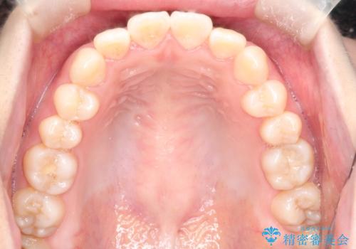 【審美ワイヤー】口ボコをなおしたいの治療前