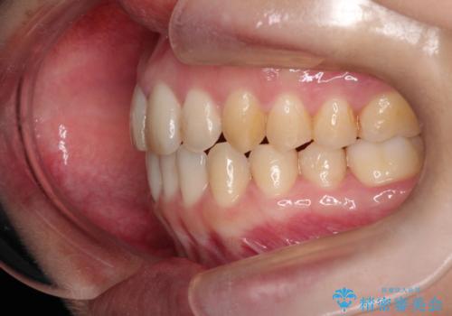 【出っ歯(飛び出した前歯)・がたつきでお悩みの方必見】インビザライン矯正の症例の治療後