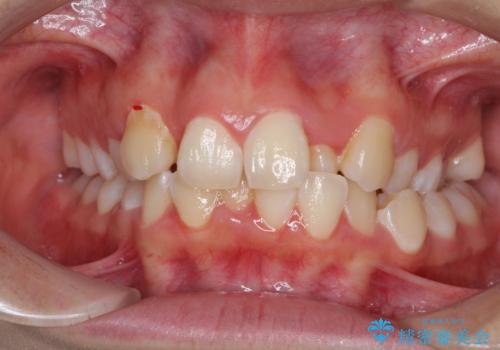 骨格的なズレをカムフラージュ　抜歯矯正で咬み合わせを改善の症例 治療前