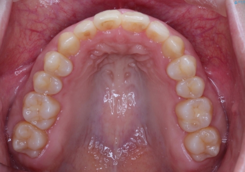 【出っ歯(飛び出した前歯)・がたつきでお悩みの方必見】インビザライン矯正の症例の治療後