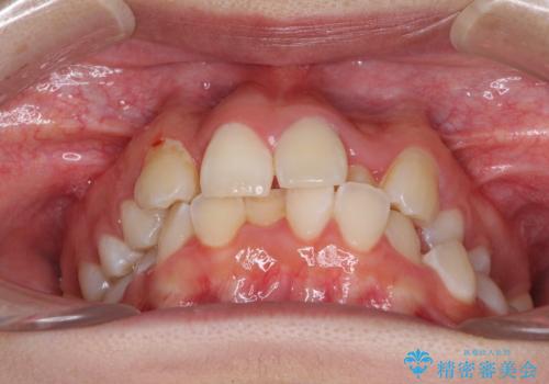 骨格的なズレをカムフラージュ 抜歯矯正で咬み合わせを改善の治療前