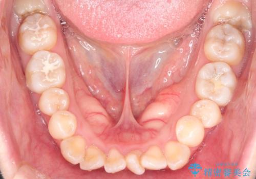 【審美ワイヤー】口ボコをなおしたいの治療前