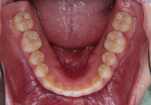 【出っ歯(飛び出した前歯)・がたつきでお悩みの方必見】インビザライン矯正の症例の治療後