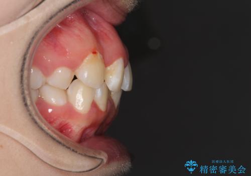 骨格的なズレをカムフラージュ 抜歯矯正で咬み合わせを改善の治療前