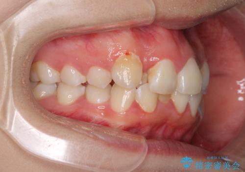 骨格的なズレをカムフラージュ　抜歯矯正で咬み合わせを改善の治療前