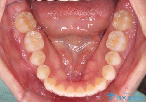 【モニター】インビザラインで口を閉じやすくの治療中
