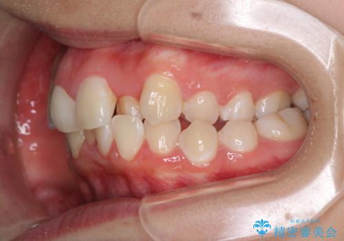 骨格的なズレをカムフラージュ 抜歯矯正で咬み合わせを改善の治療前