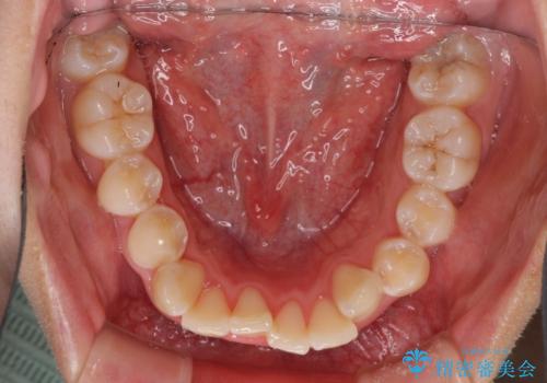 骨格的なズレをカムフラージュ 抜歯矯正で咬み合わせを改善の治療前