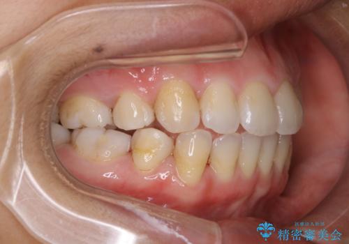 1年ぶりのクリーニング(PMTC)の治療後