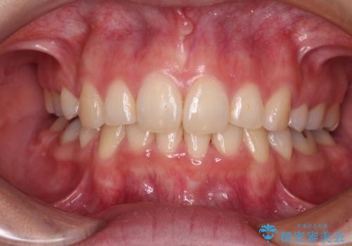 デコボコで飛び出した前歯 ワイヤー装置による抜歯矯正の症例 治療後