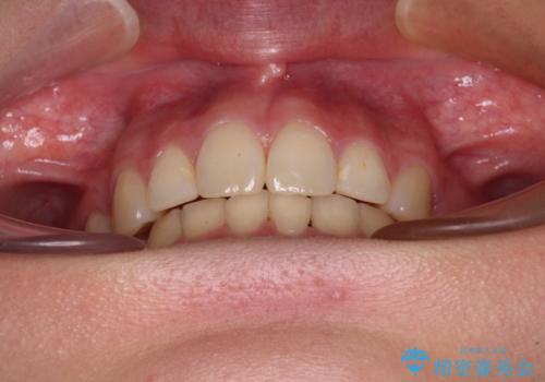 デコボコで飛び出した前歯 ワイヤー装置による抜歯矯正の治療後