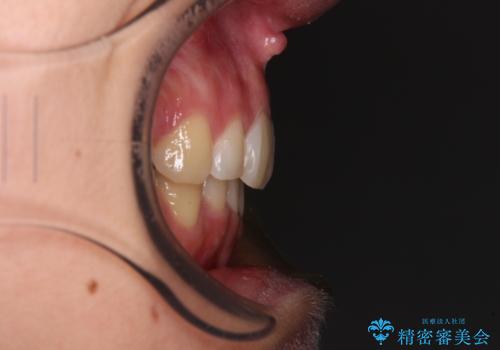 デコボコで飛び出した前歯 ワイヤー装置による抜歯矯正の治療後