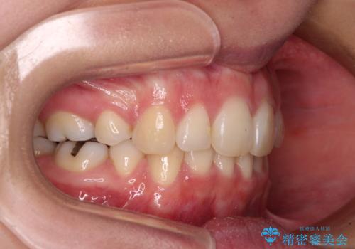 デコボコで飛び出した前歯 ワイヤー装置による抜歯矯正の治療後