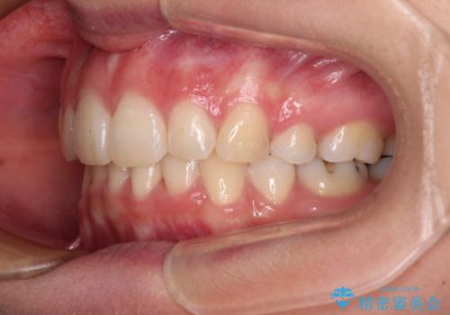 デコボコで飛び出した前歯 ワイヤー装置による抜歯矯正の治療後