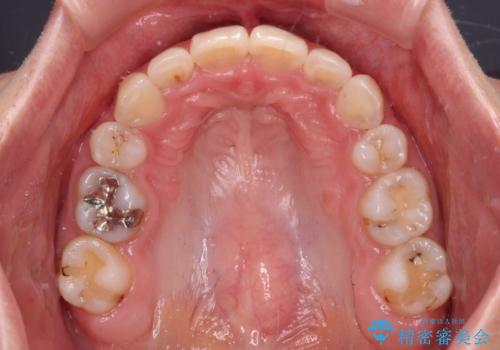 デコボコで飛び出した前歯 ワイヤー装置による抜歯矯正の治療後