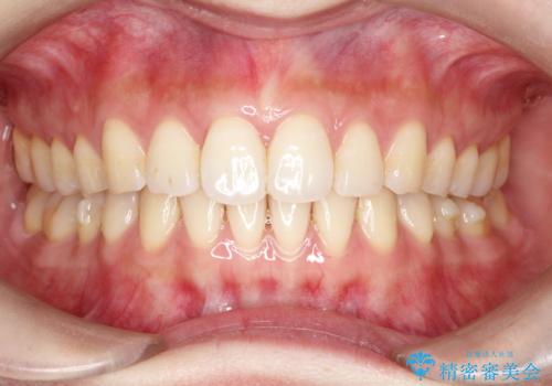 その前歯の捻じれ、原因は奥歯の噛み合わせのズレにあります。の症例 治療後