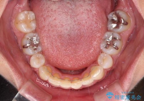 デコボコで飛び出した前歯 ワイヤー装置による抜歯矯正の治療後