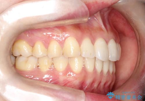 その前歯の捻じれ、原因は奥歯の噛み合わせのズレにあります。の治療後