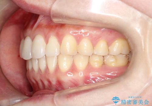 その前歯の捻じれ、原因は奥歯の噛み合わせのズレにあります。の治療後