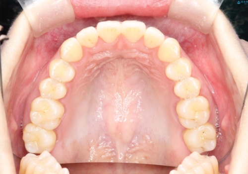 その前歯の捻じれ、原因は奥歯の噛み合わせのズレにあります。の治療後