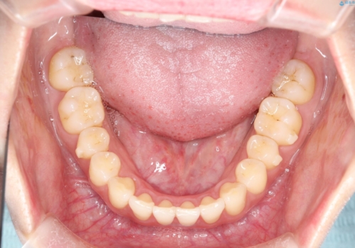 その前歯の捻じれ、原因は奥歯の噛み合わせのズレにあります。の治療後